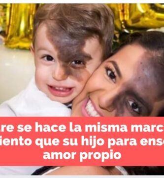 Mamá demuestra amor a su hijo haciendose la misma marca de naciemiento